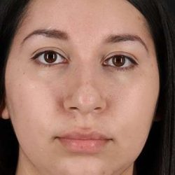 Chin Implant Before & After Patient #1604
