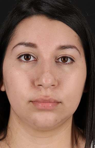 Chin Implant Before & After Patient #1604