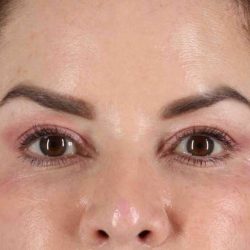Browlift Before & After Patient #1253