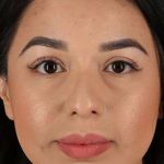 Chin Implant Before & After Patient #1626