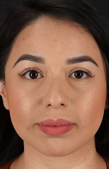 Chin Implant Before & After Patient #1626