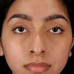 Chin Implant Before & After Patient #1637