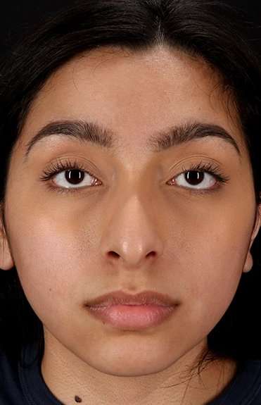 Chin Implant Before & After Patient #1637