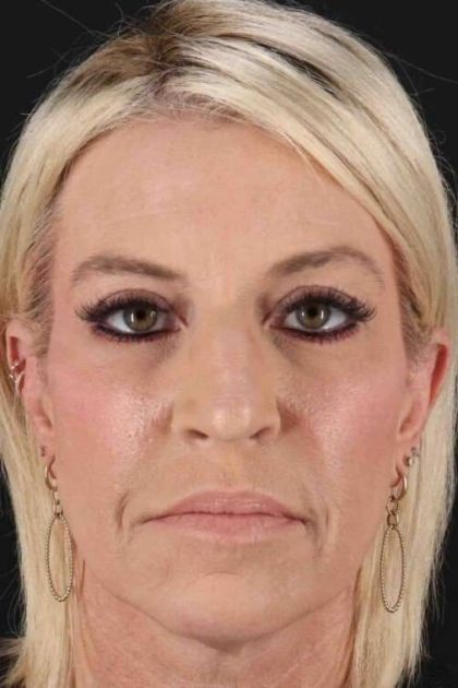 Browlift Before & After Patient #1209