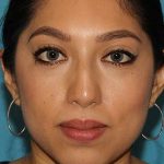 Chin Implant Before & After Patient #1670