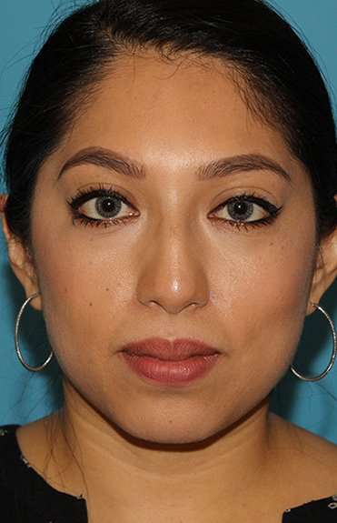 Chin Implant Before & After Patient #1670