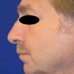Chin Implant Before & After Patient #1673