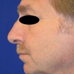 Chin Implant Before & After Patient #1673