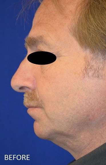 Chin Implant Before & After Patient #1673