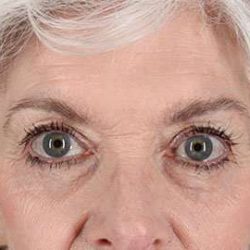 Eyelid Lift Before & After Patient #1676