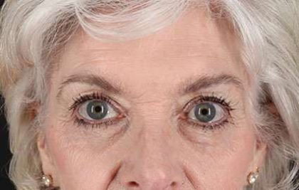 Eyelid Lift Before & After Patient #1676