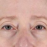 Eyelid Lift Before & After Patient #1679