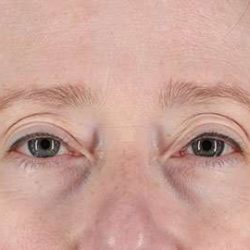 Eyelid Lift Before & After Patient #1679
