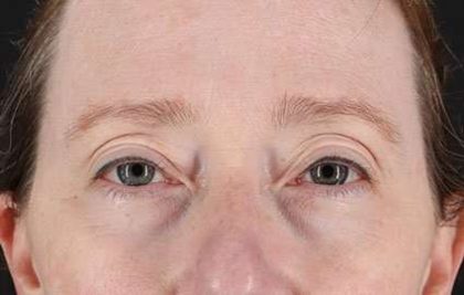 Eyelid Lift Before & After Patient #1679