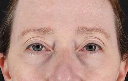 Eyelid Lift Before & After Patient #1679