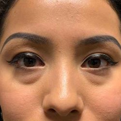 Eyelid Lift Before & After Patient #1682