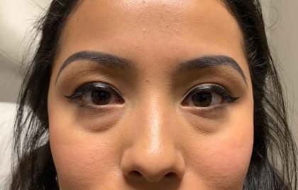 Eyelid Lift Before & After Patient #1682