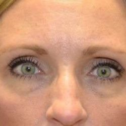 Eyelid Lift Before & After Patient #1685