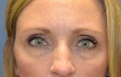 Eyelid Lift Before & After Patient #1685