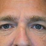 Eyelid Lift Before & After Patient #1688