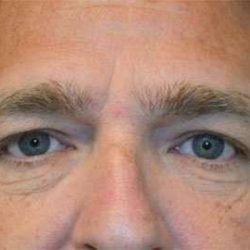 Eyelid Lift Before & After Patient #1688
