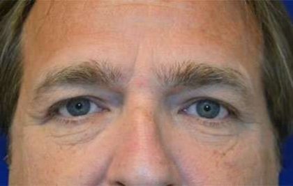 Eyelid Lift Before & After Patient #1688