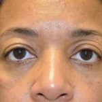 Eyelid Lift Before & After Patient #1691