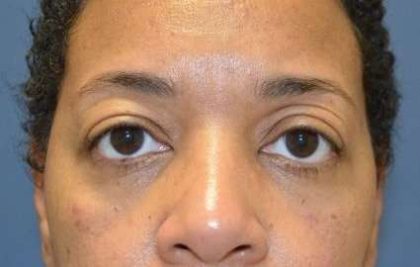 Eyelid Lift Before & After Patient #1691