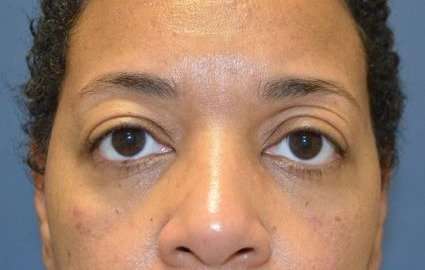 Eyelid Lift Before & After Patient #1691