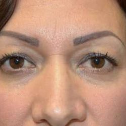 Eyelid Lift Before & After Patient #1694