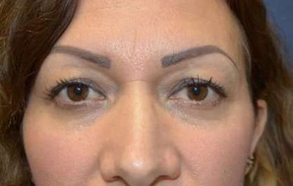 Eyelid Lift Before & After Patient #1694
