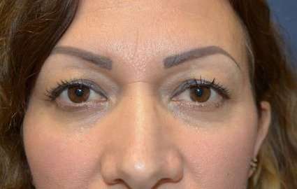 Eyelid Lift Before & After Patient #1694