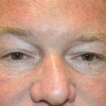 Eyelid Lift Before & After Patient #1697