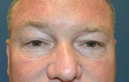 Eyelid Lift Before & After Patient #1697