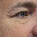 Eyelid Lift Before & After Patient #1700