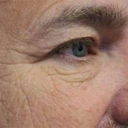 Eyelid Lift Before & After Patient #1700