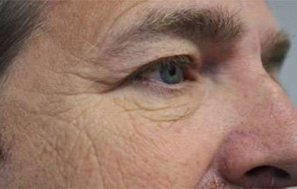 Eyelid Lift Before & After Patient #1700