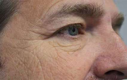 Eyelid Lift Before & After Patient #1700