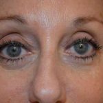 Eyelid Lift Before & After Patient #1703