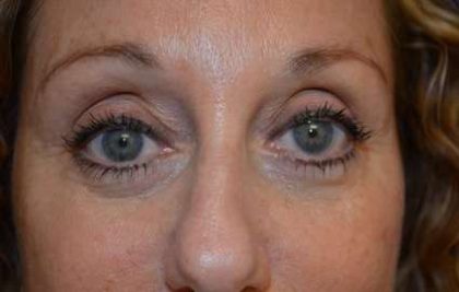 Eyelid Lift Before & After Patient #1703