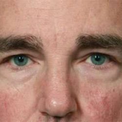 Eyelid Lift Before & After Patient #1706