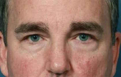 Eyelid Lift Before & After Patient #1706