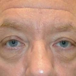 Eyelid Lift Before & After Patient #1709