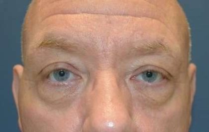 Eyelid Lift Before & After Patient #1709