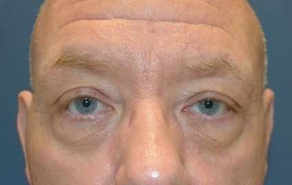 Eyelid Lift Before & After Patient #1709