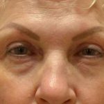 Eyelid Lift Before & After Patient #1712