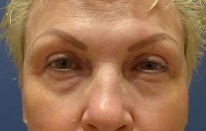 Eyelid Lift Before & After Patient #1712