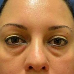 Eyelid Lift Before & After Patient #1715