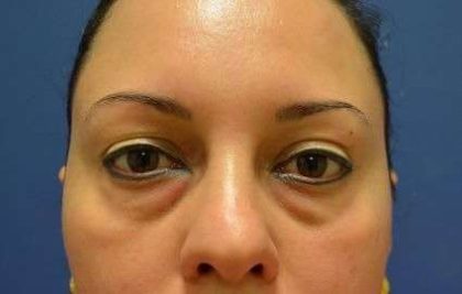 Eyelid Lift Before & After Patient #1715