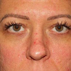 Eyelid Lift Before & After Patient #1718